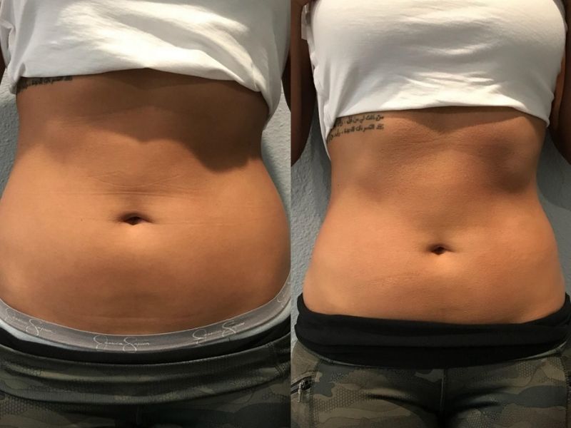 Fat Freezing at Cryoskin Australia – What to Expect