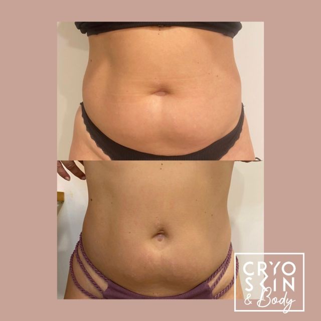 Incredible results after just two treatments for this client who was looking to treat stubborn belly fat or the common ‘mum tum’! "It felt like I'd done a hundred crunches after the treatment but really it was zero pain, I'm so happy with the results!"
.
.
.
#cryoskinandbody #cryosunshinecoast #bodysculpting #fatfreezing #fatfreezingsunshinecoast  #selfcare #antiaging #bodysculpting #healthylifestyle #cryoskinfacial #cryoskinslimming #slimming #fatloss #healthandwellness #facelift #wellness #beauty #skincare #fitness #health #recovery #weightloss #bodycontouring #wholebodycryotherapy #cryotherapybenefits #coolsculpting #seeresults